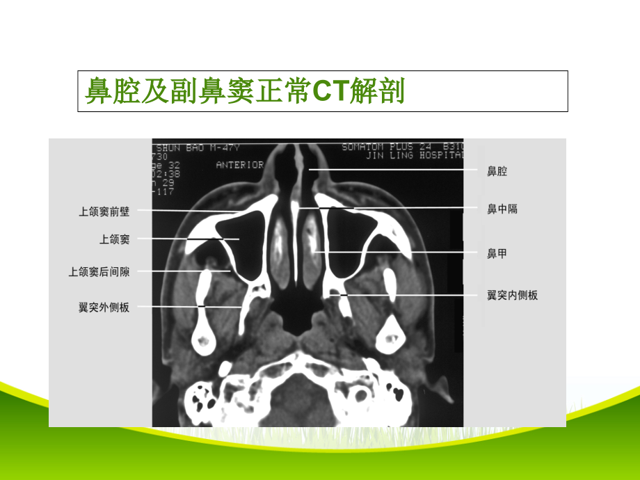 鼻和鼻窦病变CT诊断.ppt_第1页