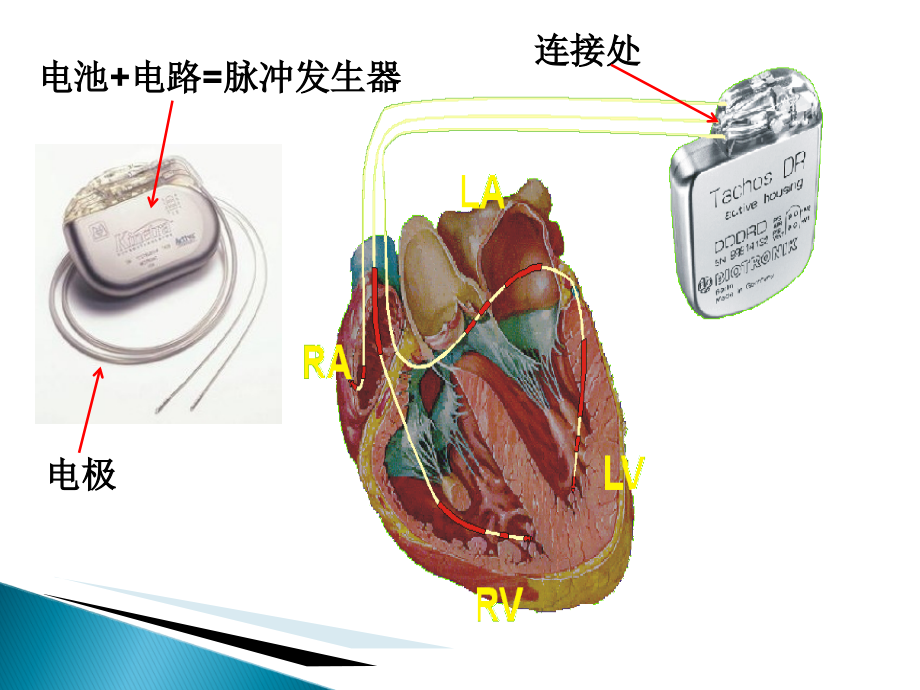 永久性人工起搏器植入术后囊袋并发症的预防和医疗护理.ppt_第2页