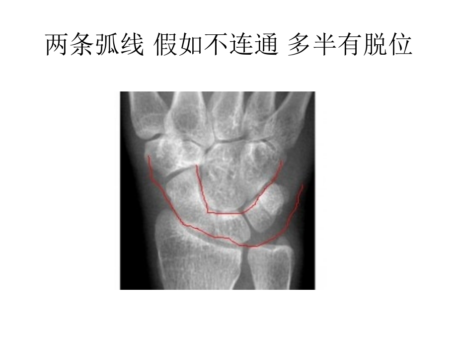 腕关节阅片技巧.pptx_第2页