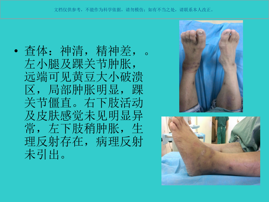 踝关节融合术的最进展的讨论学习课件.ppt_第2页