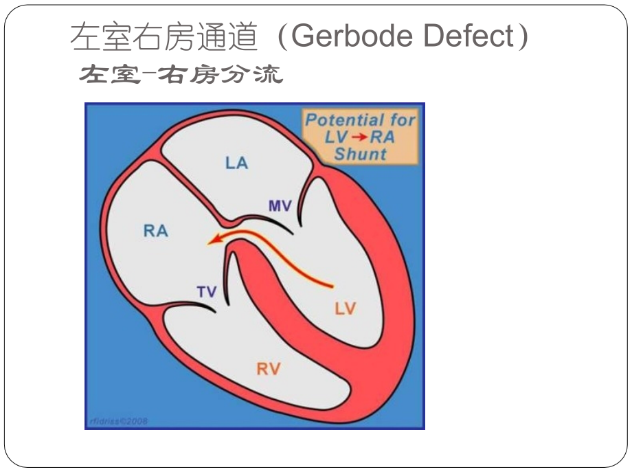 左室右房通道介入治疗专家讲座.ppt_第2页