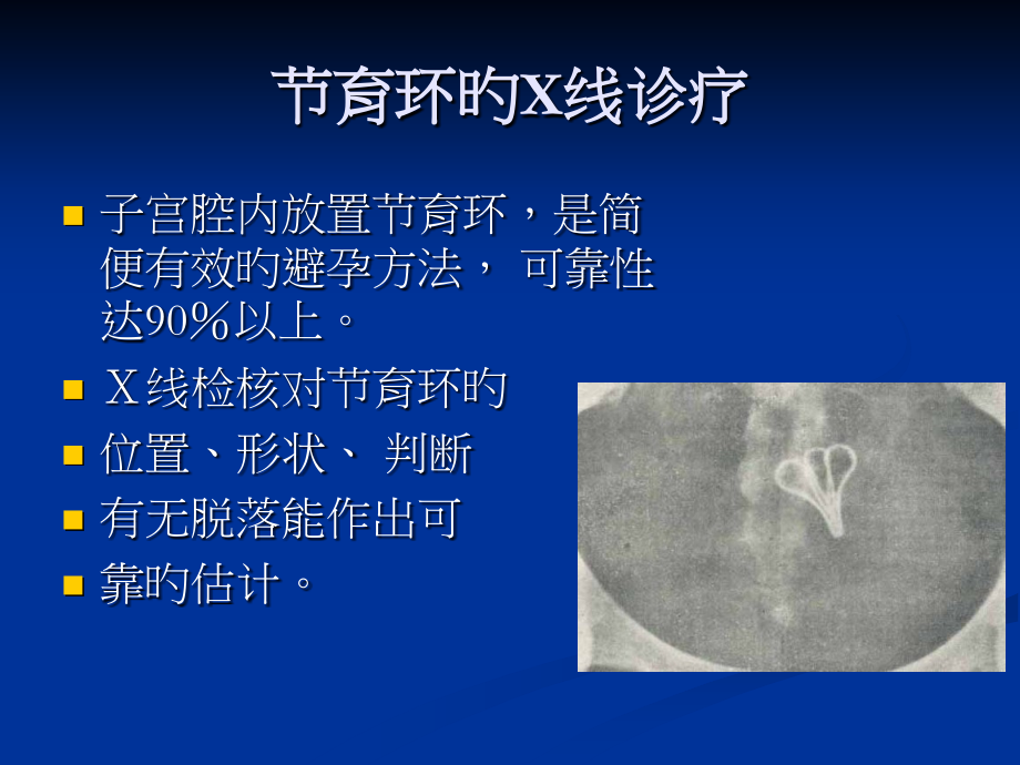 宫内节育器的X线诊断.ppt_第2页