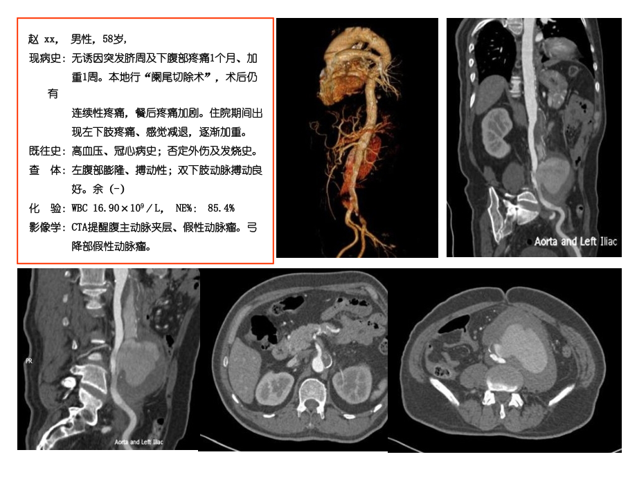 特殊动脉瘤的腔内治疗策略病例分享.ppt_第2页