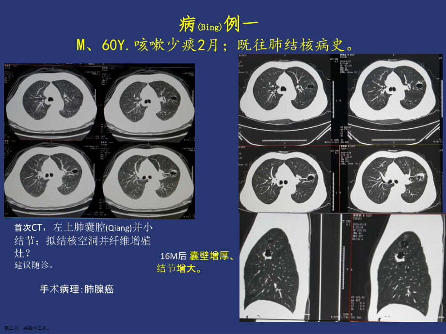 薄壁囊腔型肺癌的影像诊断与治疗教学.pptx_第2页