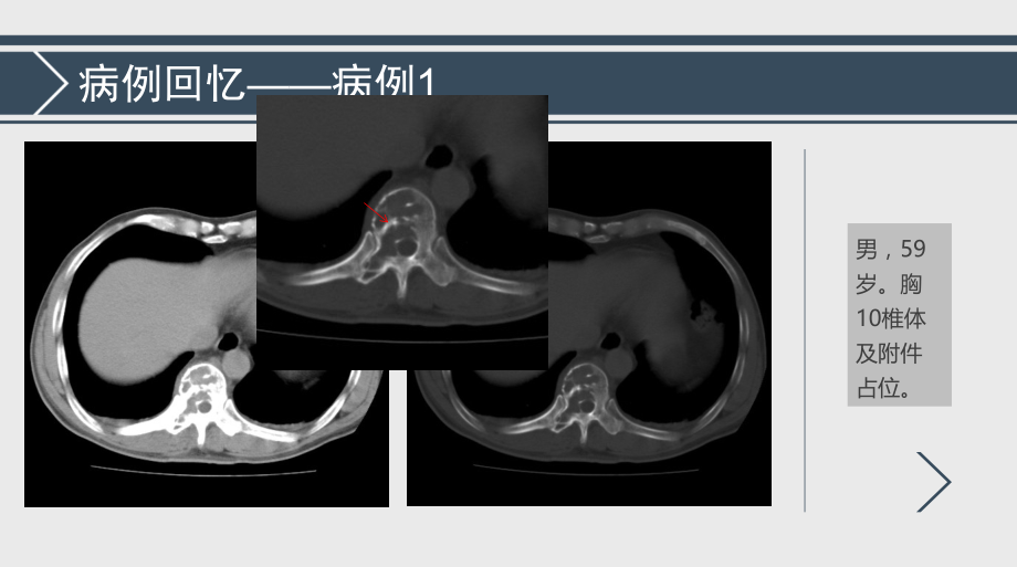 孤立性浆细胞瘤诊断与鉴别诊断.ppt_第1页