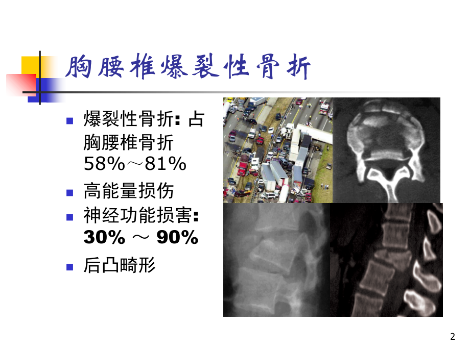 胸腰椎爆裂性骨折的治疗.ppt_第2页