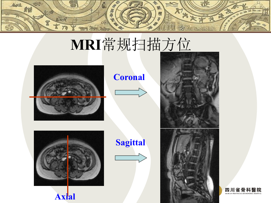 医学脊柱常见疾病的MRI诊疗.ppt_第2页