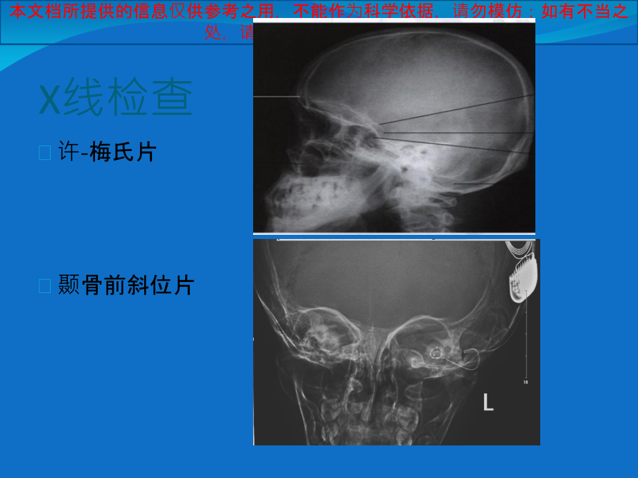 颞骨CT与疾病培训.ppt_第2页