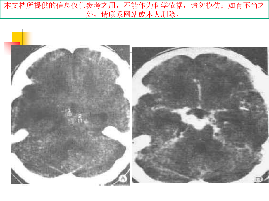 颅脑感染性疾病培训.ppt_第2页