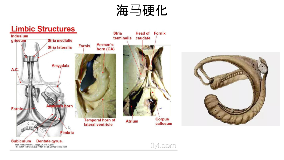 海马硬化.ppt_第2页