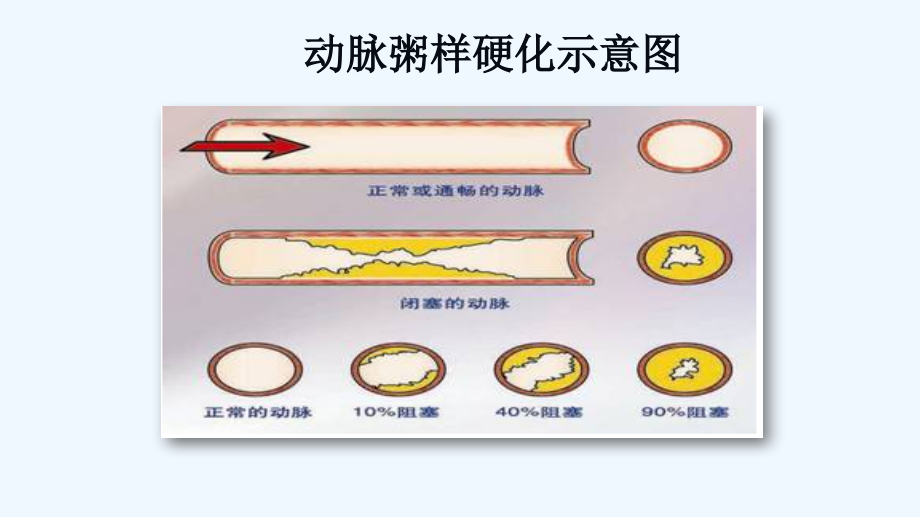下肢动脉硬化判断及处置方法总结.pptx_第2页