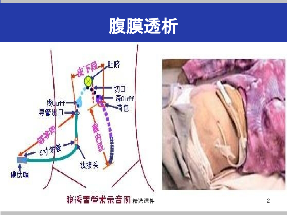 腹膜透析感染诊治.pptx_第2页