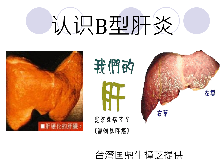 认识乙肝做好乙肝的预防.ppt_第2页