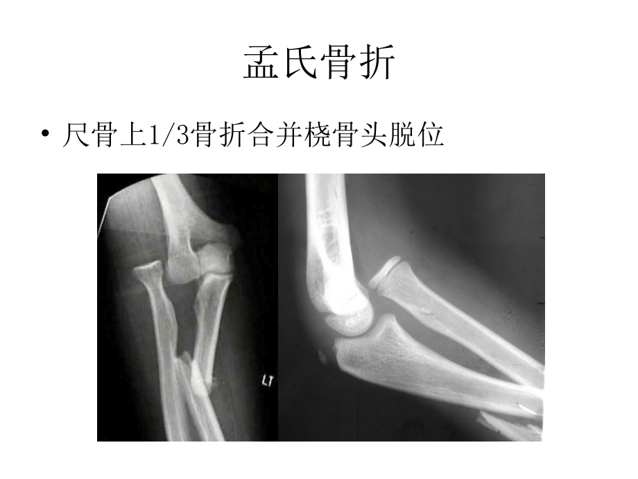 孟氏骨折和盖氏骨折的分类和治疗.ppt_第2页