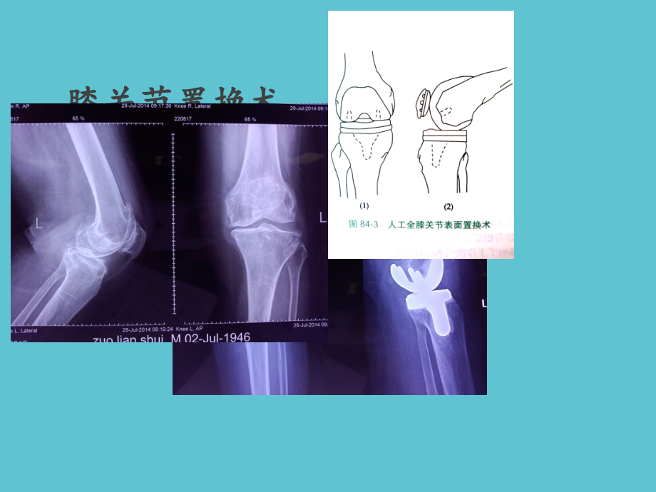 髋膝关节置换适应症和并发症.ppt_第2页