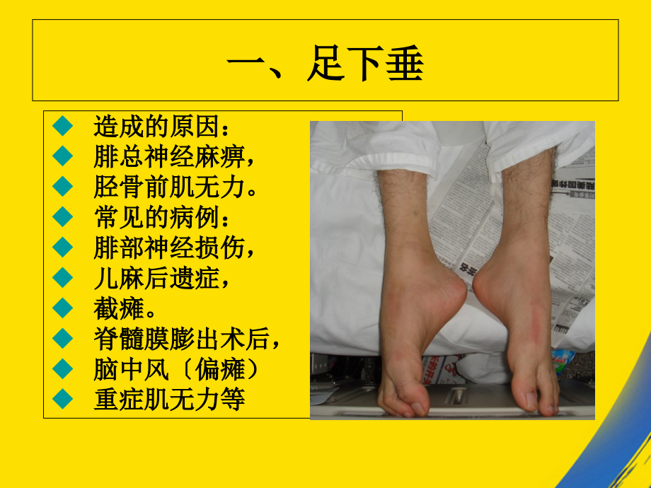异常体征与矫形器应用.ppt_第2页
