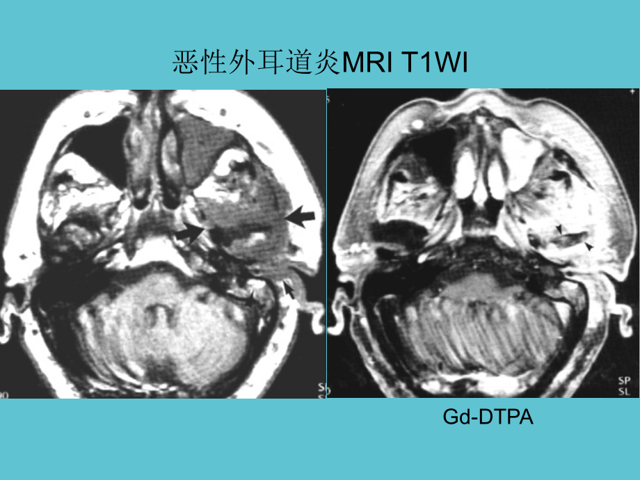 颞骨与耳部炎症及并发症同仁放射.ppt_第2页