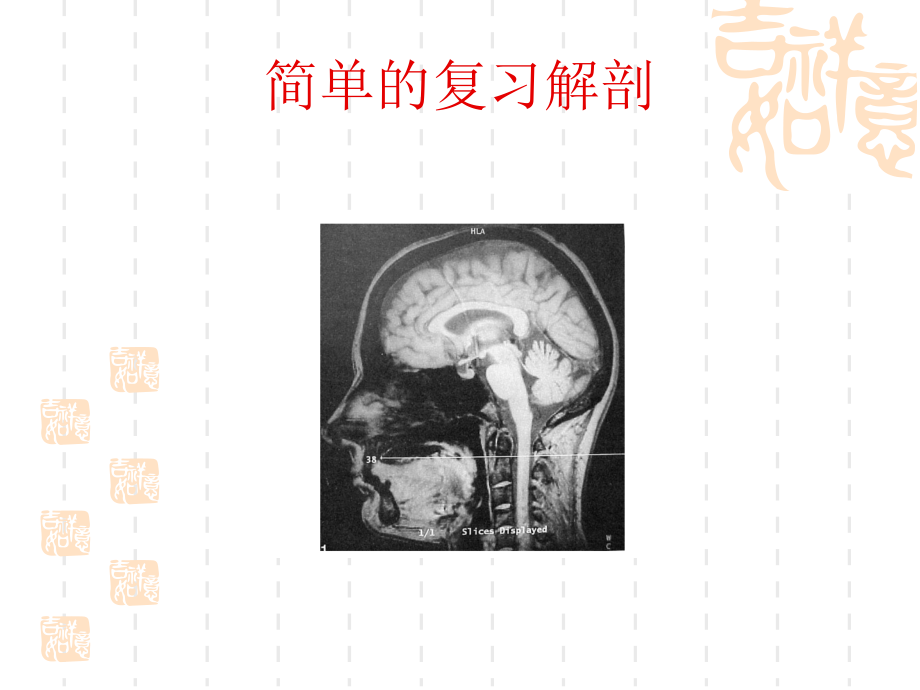 医学延髓背外侧综合征汇报课件.ppt_第2页