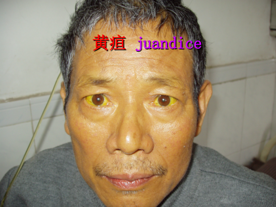 诊断学教学课件-黄疸、腹泻、呕血修改.ppt_第2页