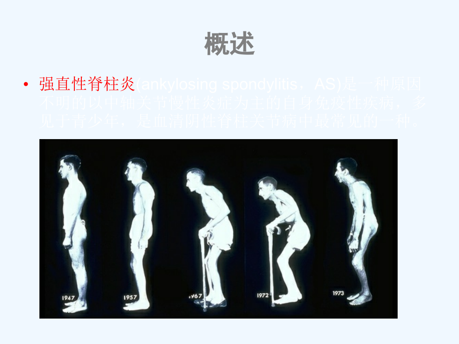 骶髂关节炎的评分比较影像FTP.ppt_第2页