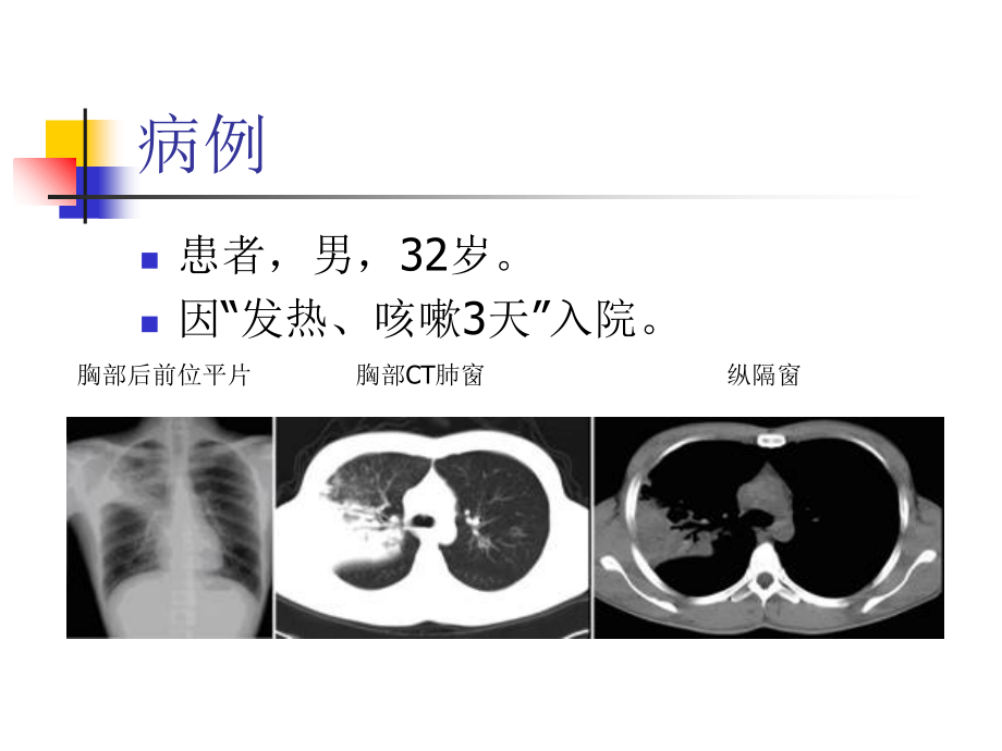 大叶性肺炎的影像诊疗.ppt_第2页