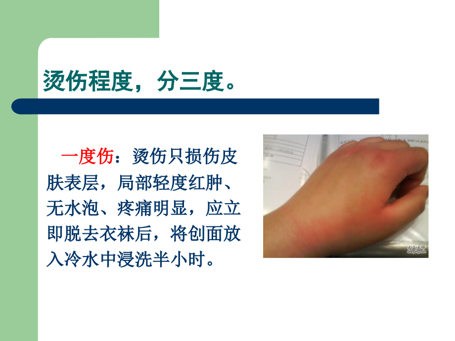烫伤急救与护理.ppt_第2页