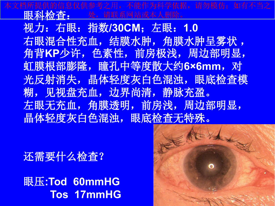 绿风内障医学培训.ppt_第2页