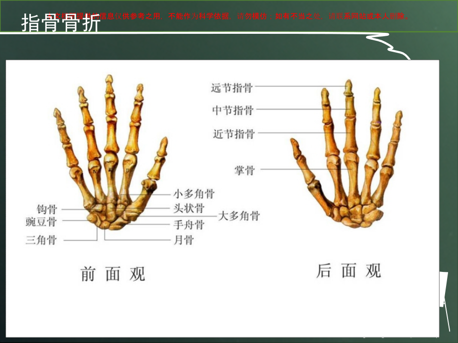指骨骨折的护理培训.ppt_第2页