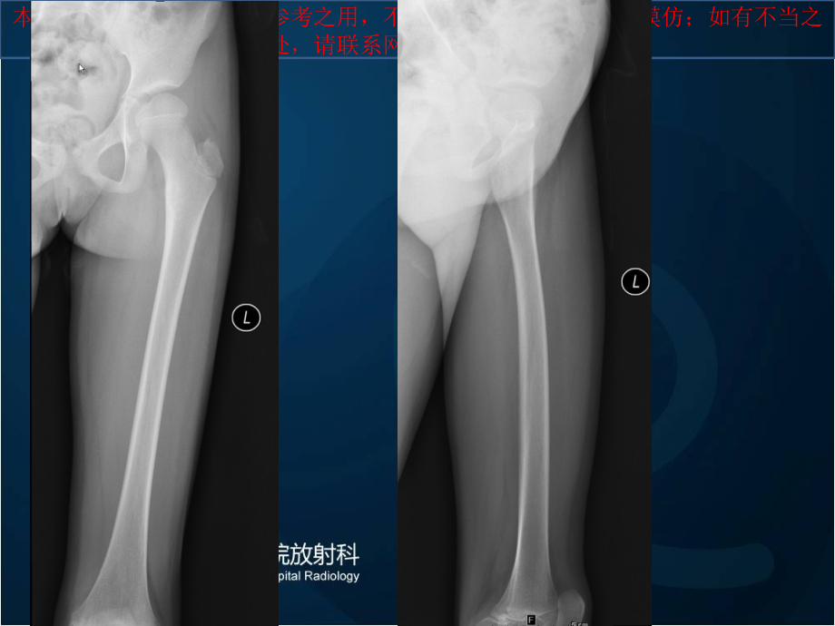 骨样骨瘤四例读片培训.ppt_第2页