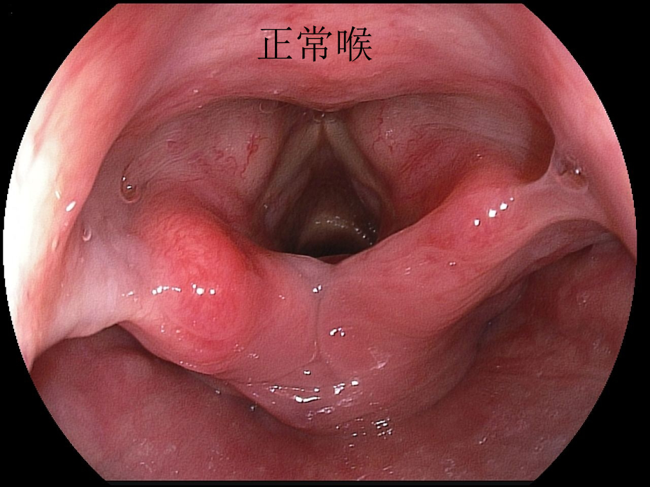 正常胃镜图片和常见病变.ppt_第2页
