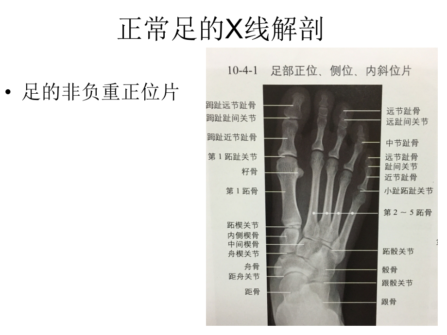 医学常见足部畸形疾病X线评估.ppt_第2页
