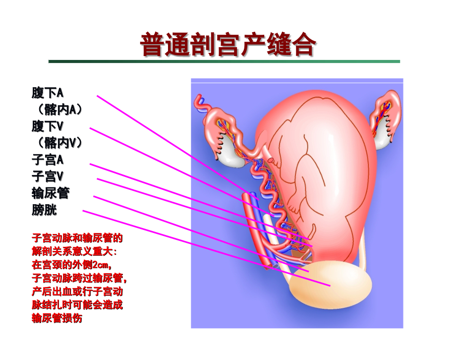 医学剖宫产手术缝合技术.ppt_第2页