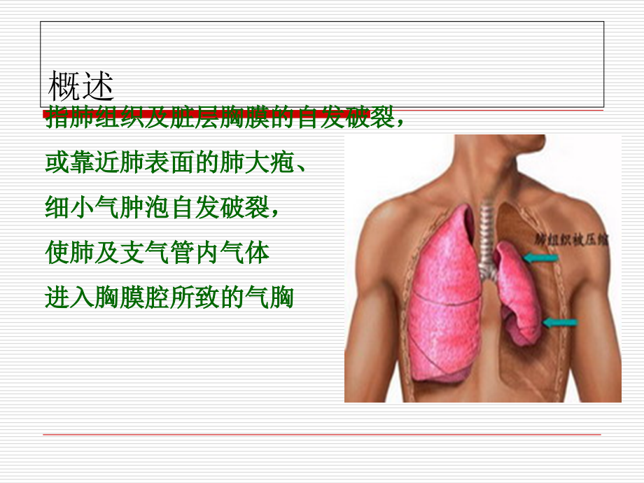 液气胸病人护理查房.ppt_第2页
