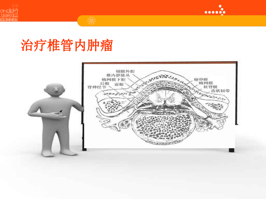 椎管内肿瘤术中神经电生理监测和神经保护.ppt_第2页
