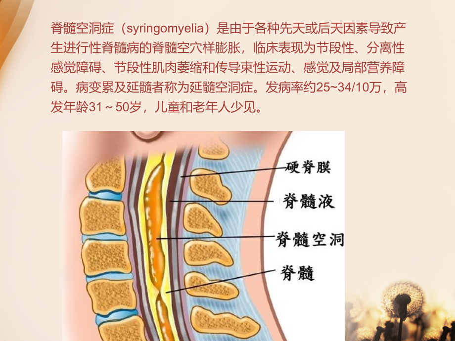医学脊髓空洞症病医疗资料.ppt_第2页