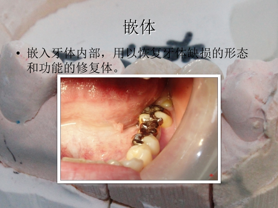 牙科嵌体知识主题讲座课件.ppt_第1页