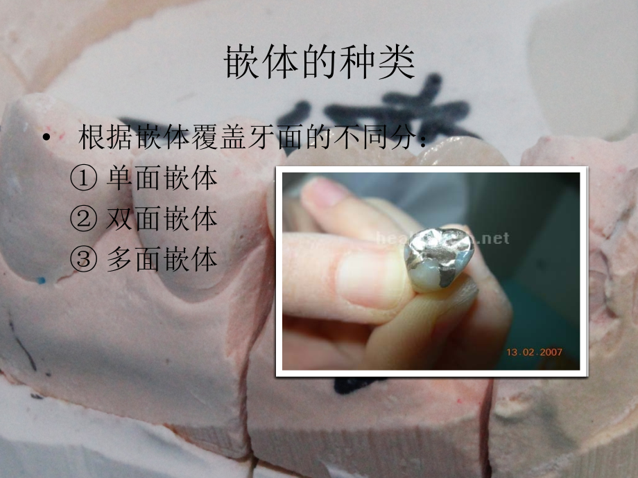 牙科嵌体知识主题讲座课件.ppt_第2页