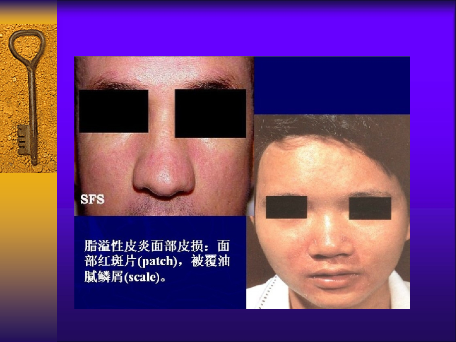 脂溢性皮炎专题讲座主题讲座课件.ppt_第1页