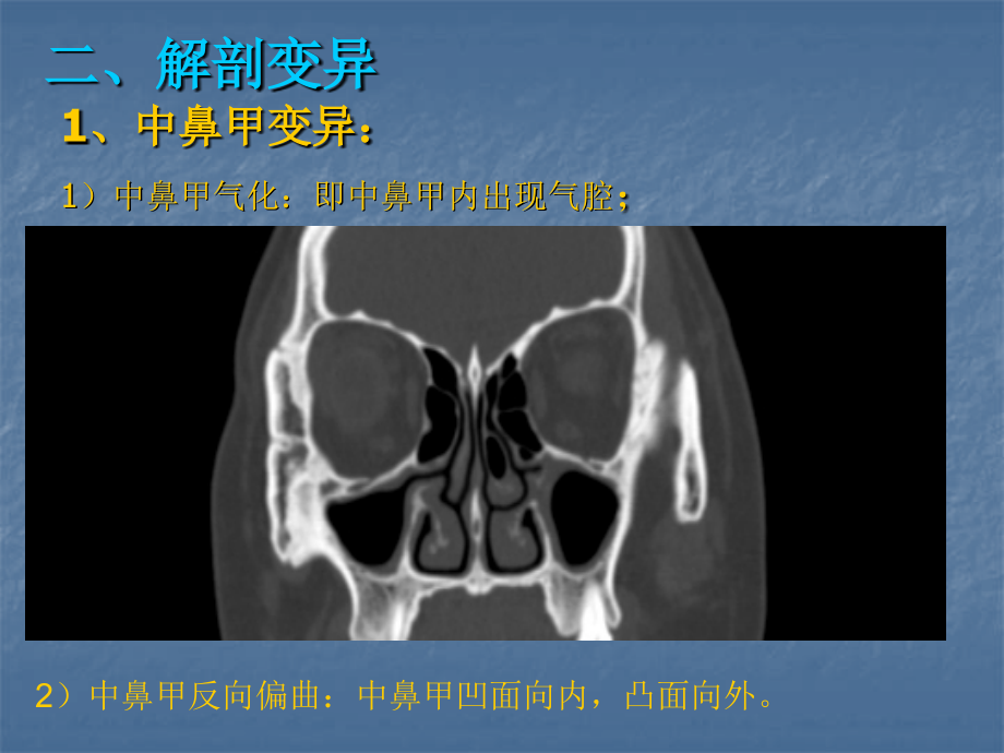 窦口鼻道复合体宣讲主题讲座课件.ppt_第1页