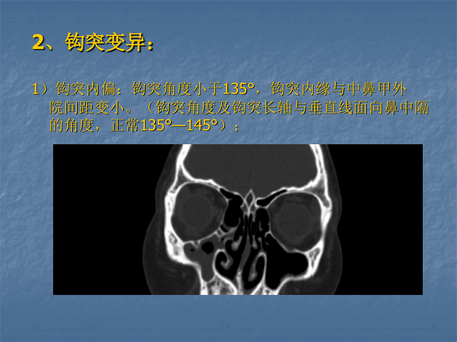 窦口鼻道复合体宣讲主题讲座课件.ppt_第2页