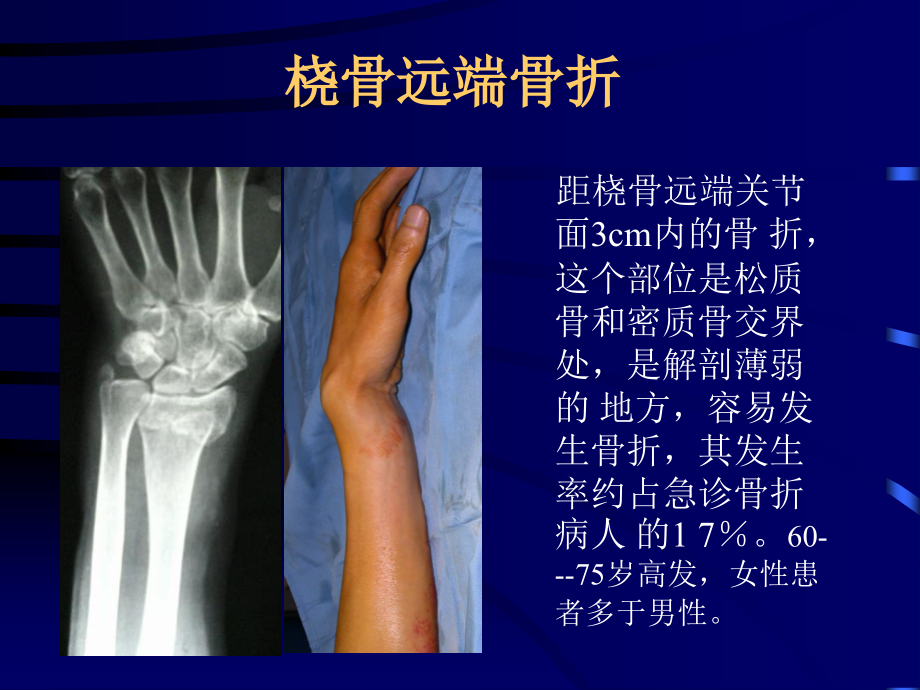 桡骨远端骨折治疗主题讲座课件.ppt_第1页