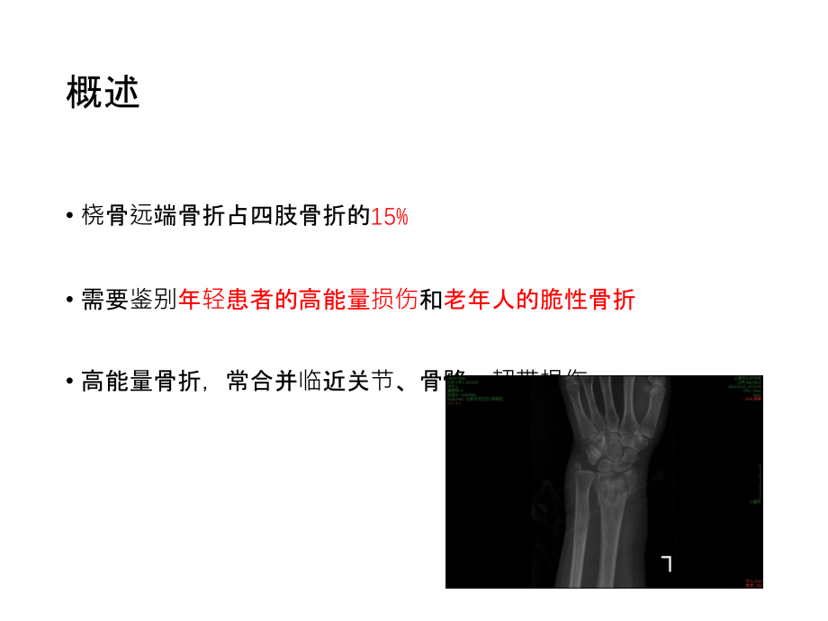 桡骨远端骨折的治疗进展主题讲座课件.ppt_第1页