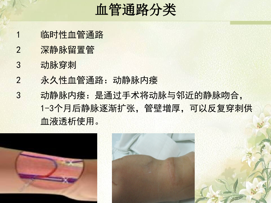 血液透析患者血管通路的护理主题讲座课件.ppt_第1页