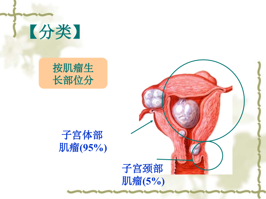 医学子宫肌瘤医疗医疗护理专题课件.ppt_第2页