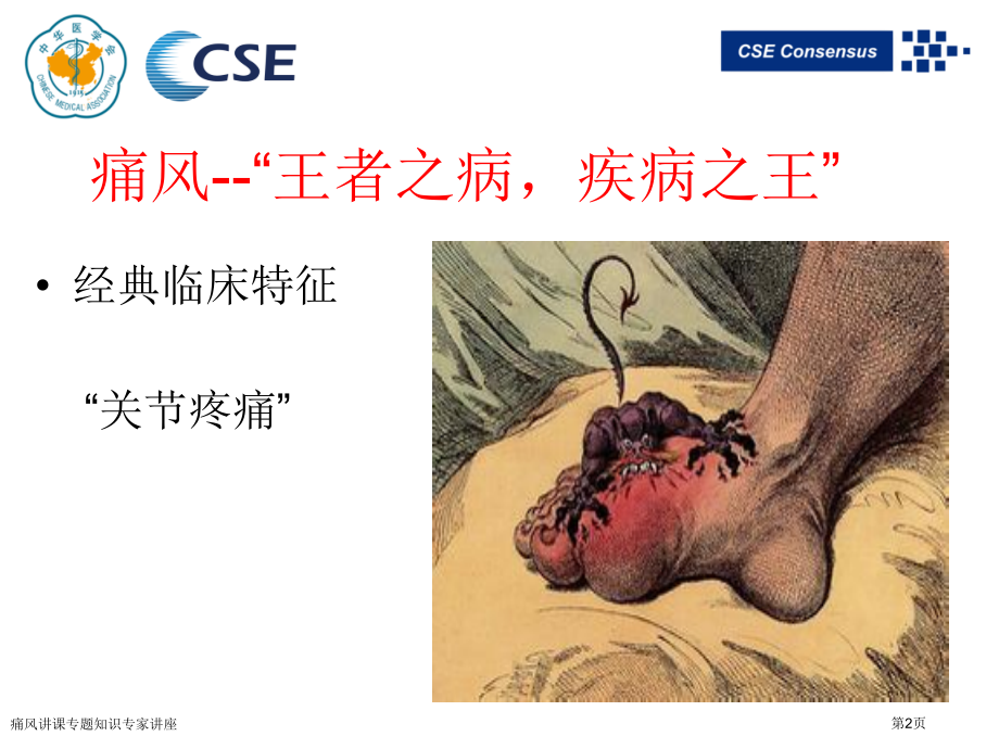 痛风讲课专题知识.pptx_第2页