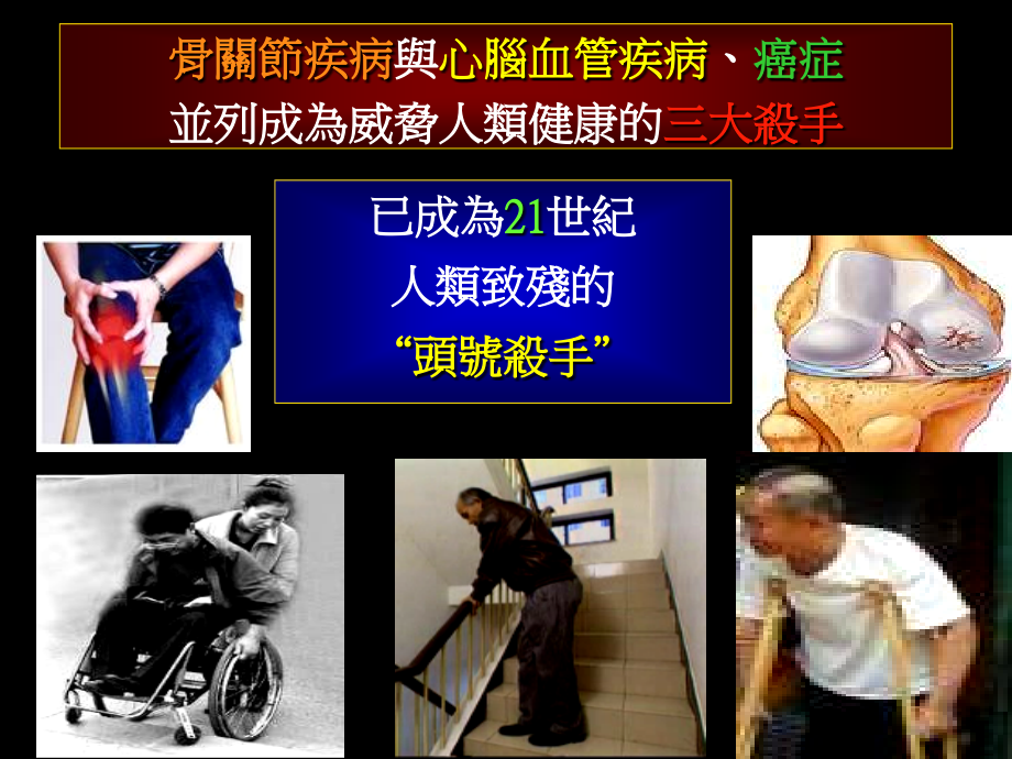 有不死的癌症恶名的骨关节病.ppt_第2页