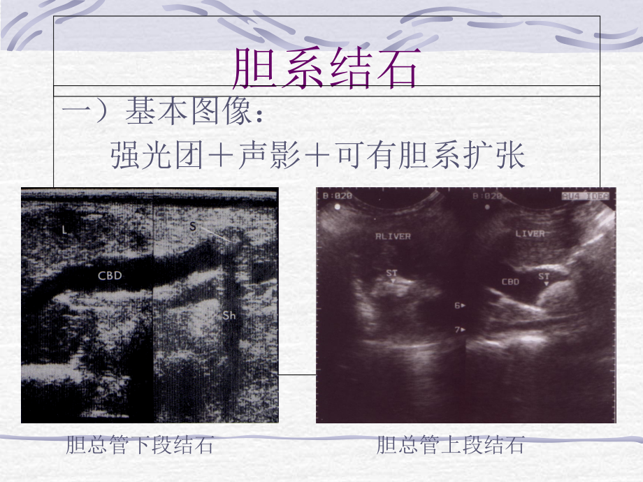 胆系常见疾病超声诊断.ppt_第1页