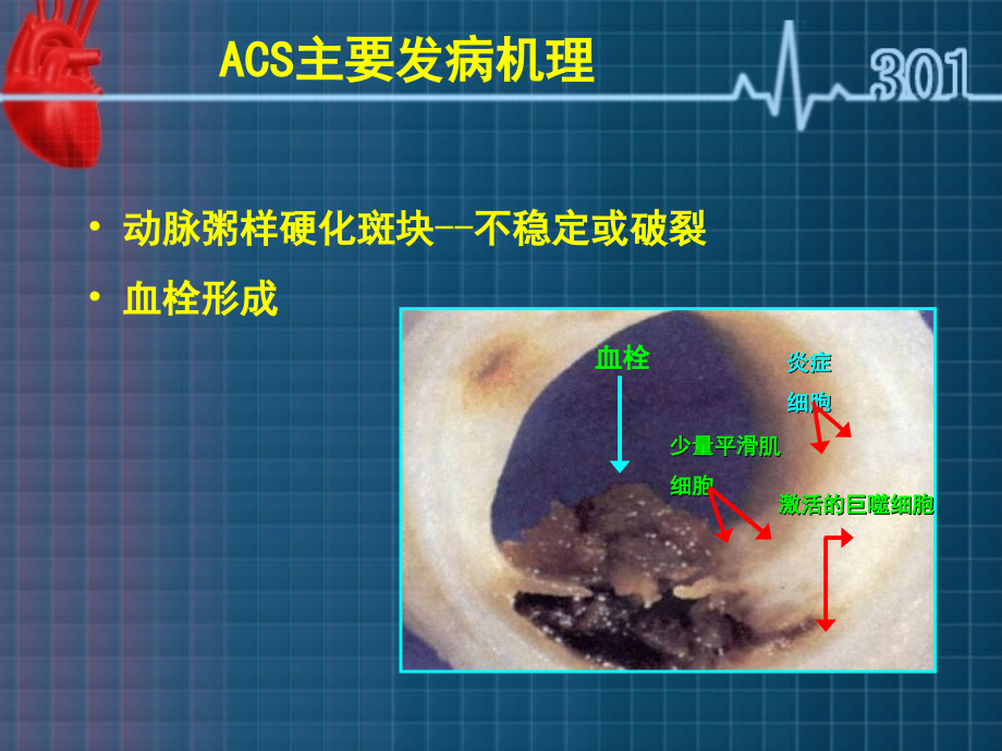 非st抬高acs早期危险分层方法的评价.ppt_第2页