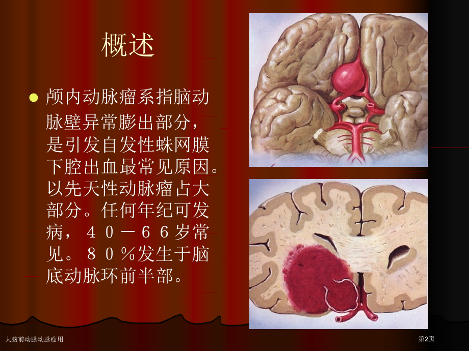 大脑前动脉动脉瘤用.pptx_第2页